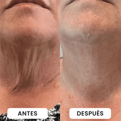 Antes y después del cuello
