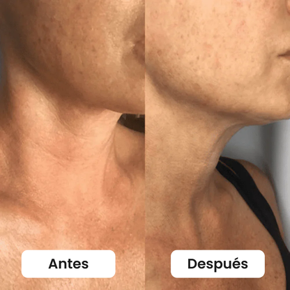 Antes y después del cuello de perfil
