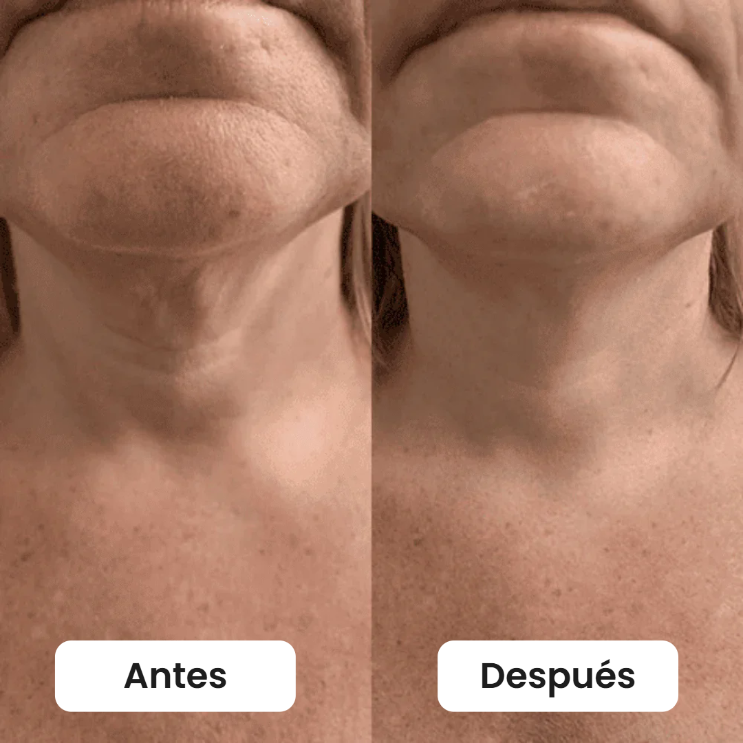 Antes y después bajo la barbilla