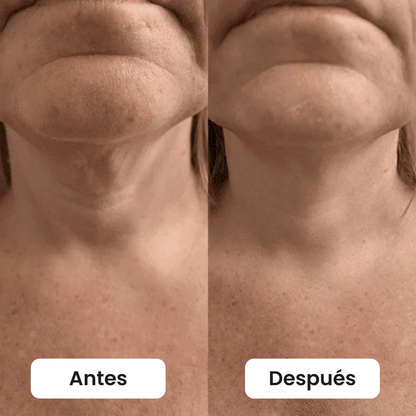 Antes y después bajo la barbilla