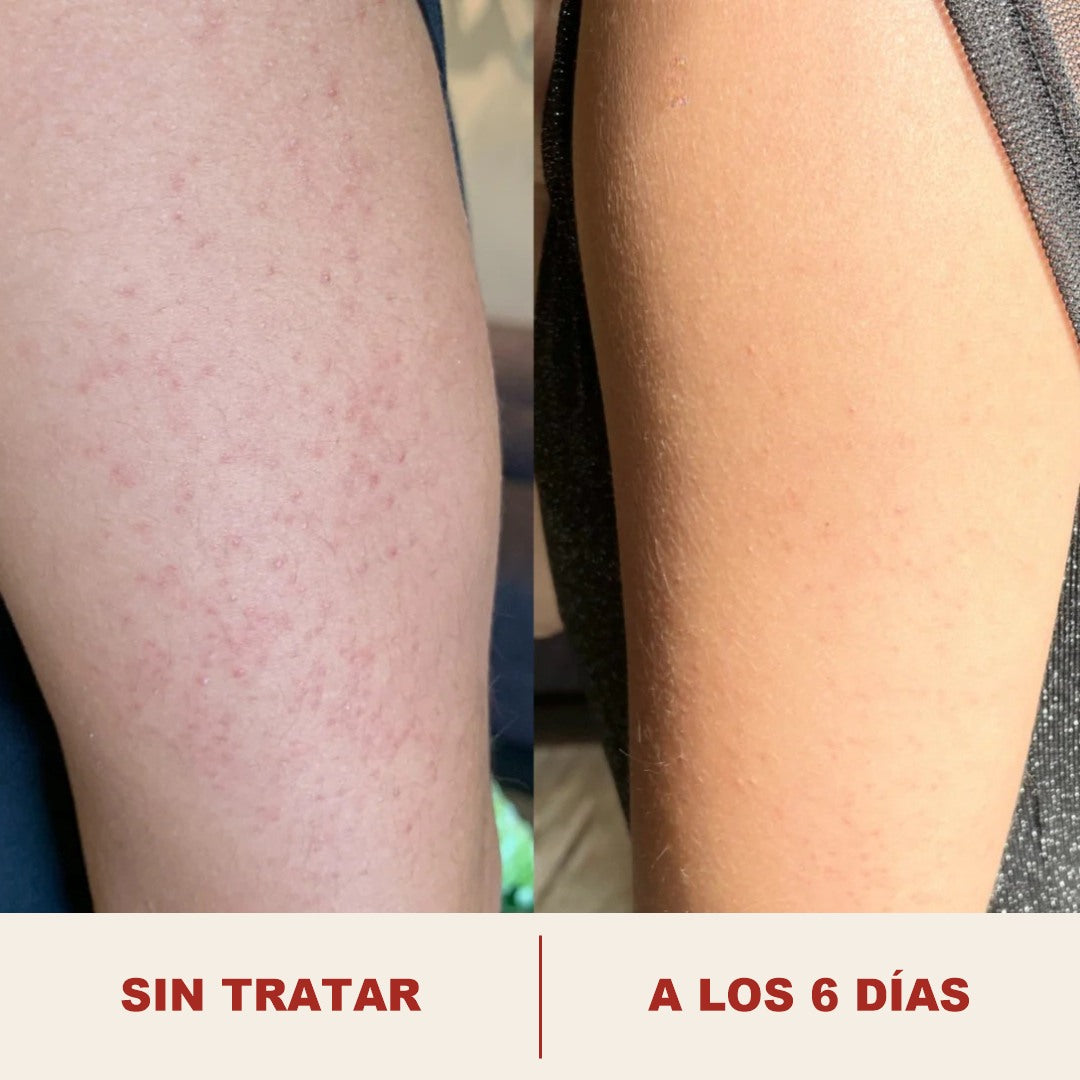 Brazo antes y a los seis dias
