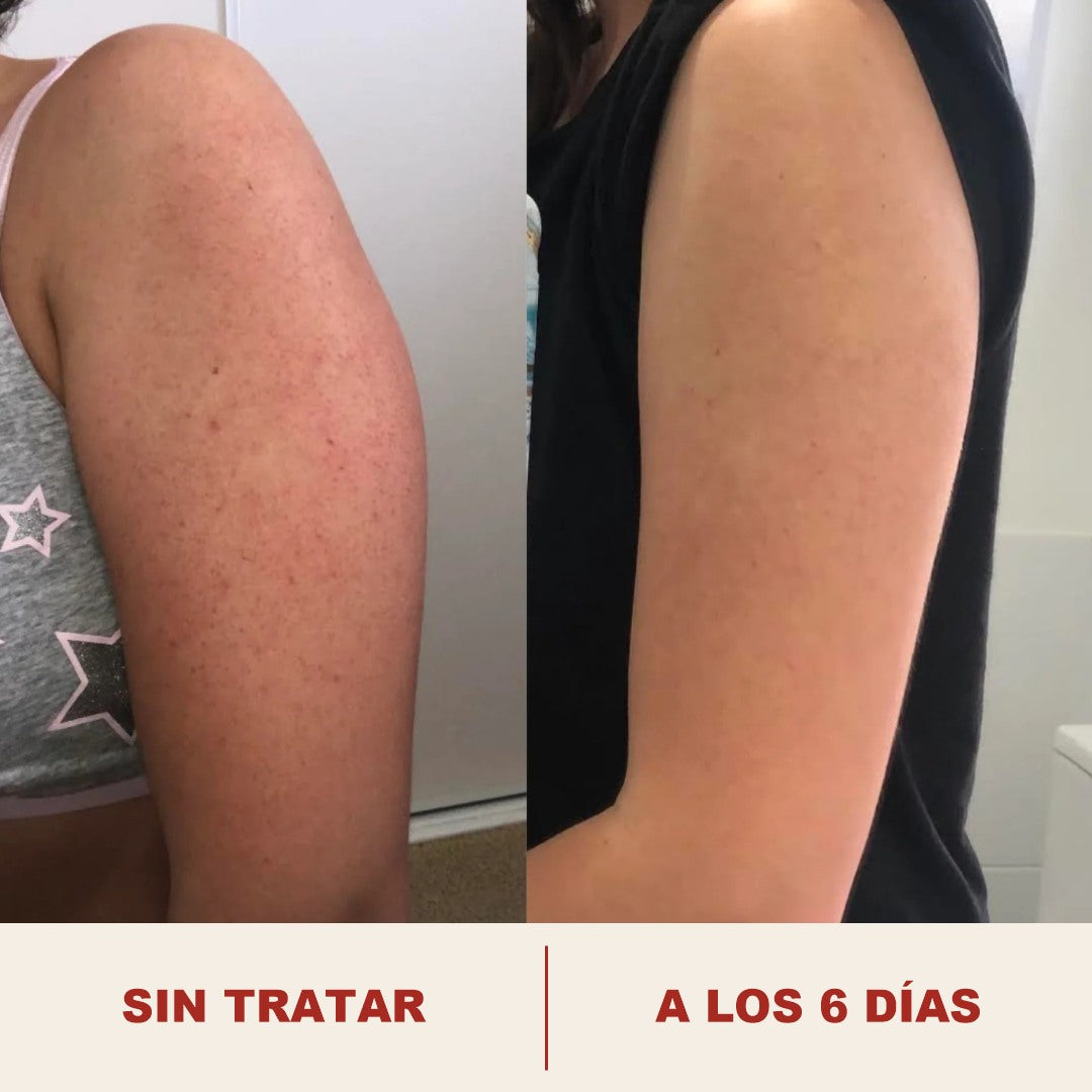 Brazo antes y a los seis dias