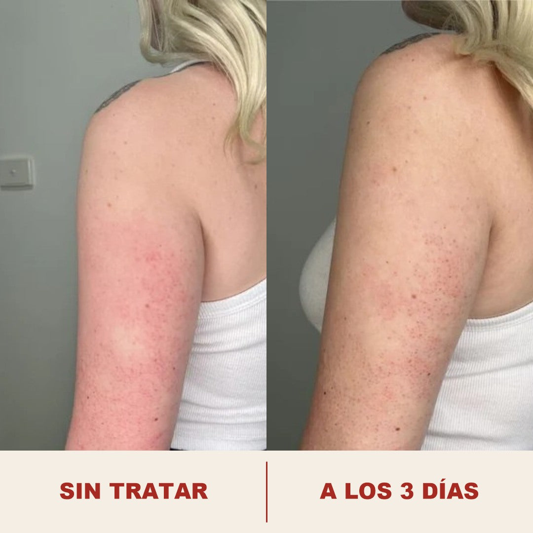 Brazo antes y a los tres dias