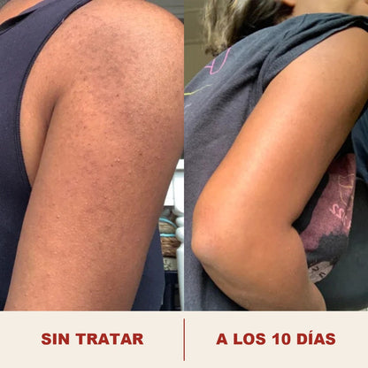 Brazo antes y a los diez dias