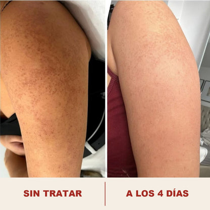 Muslo antes y a los cuatro dias