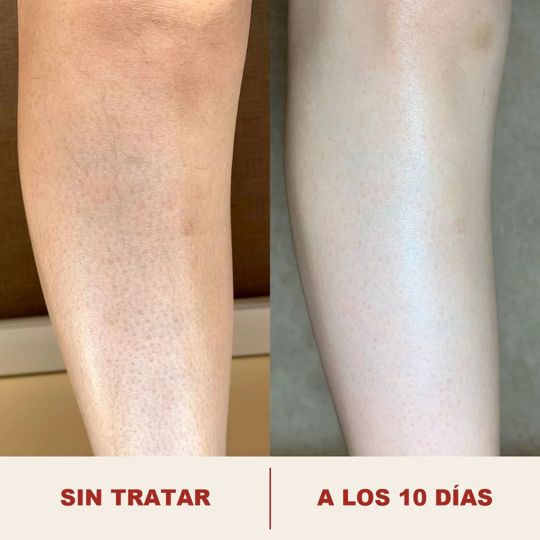 Pierna antes y a los diez dias