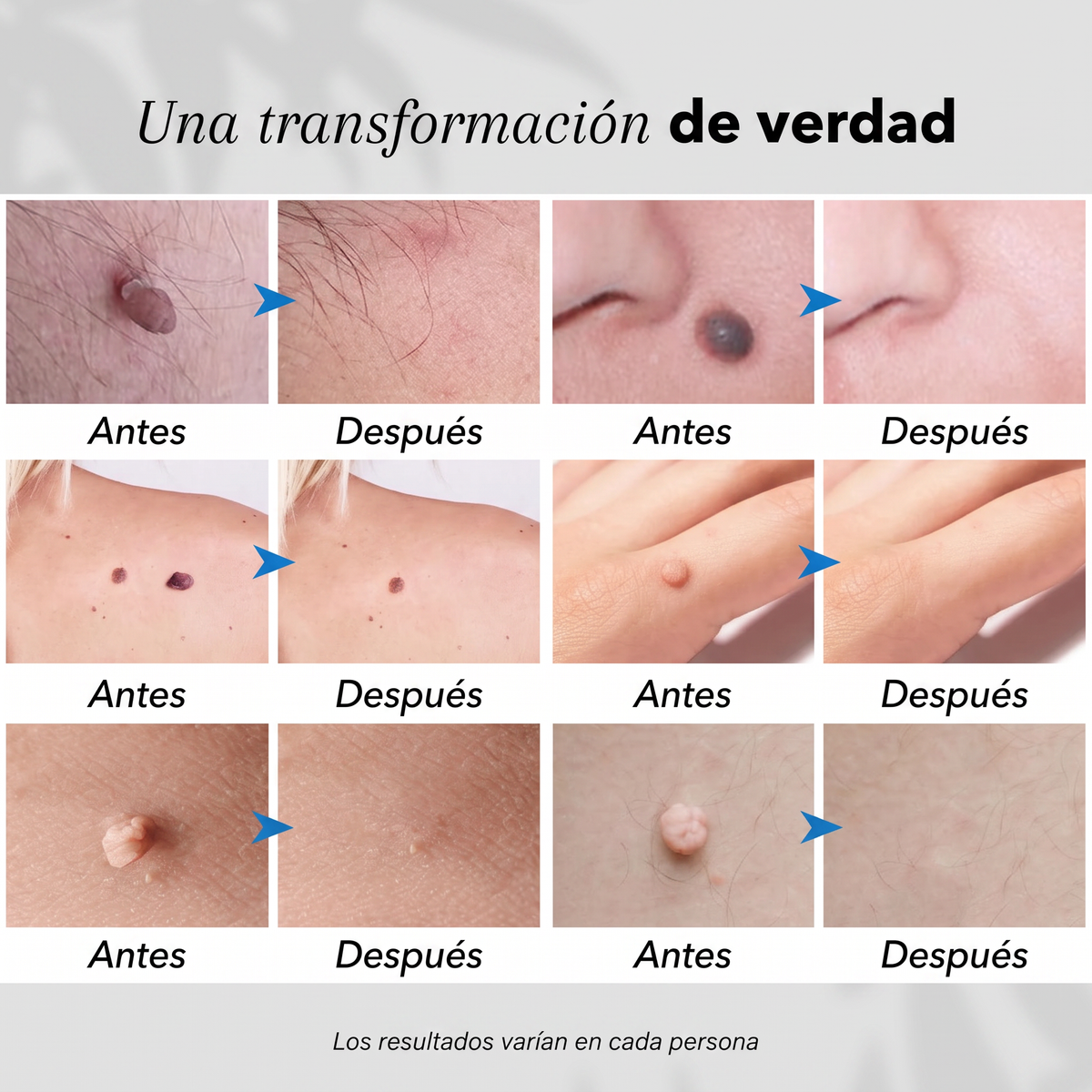 Antes y después de lunares, verrugas y puntos rojos