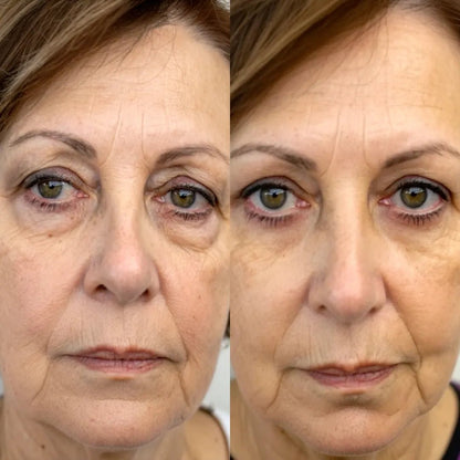 Antes y después del contorno de ojos