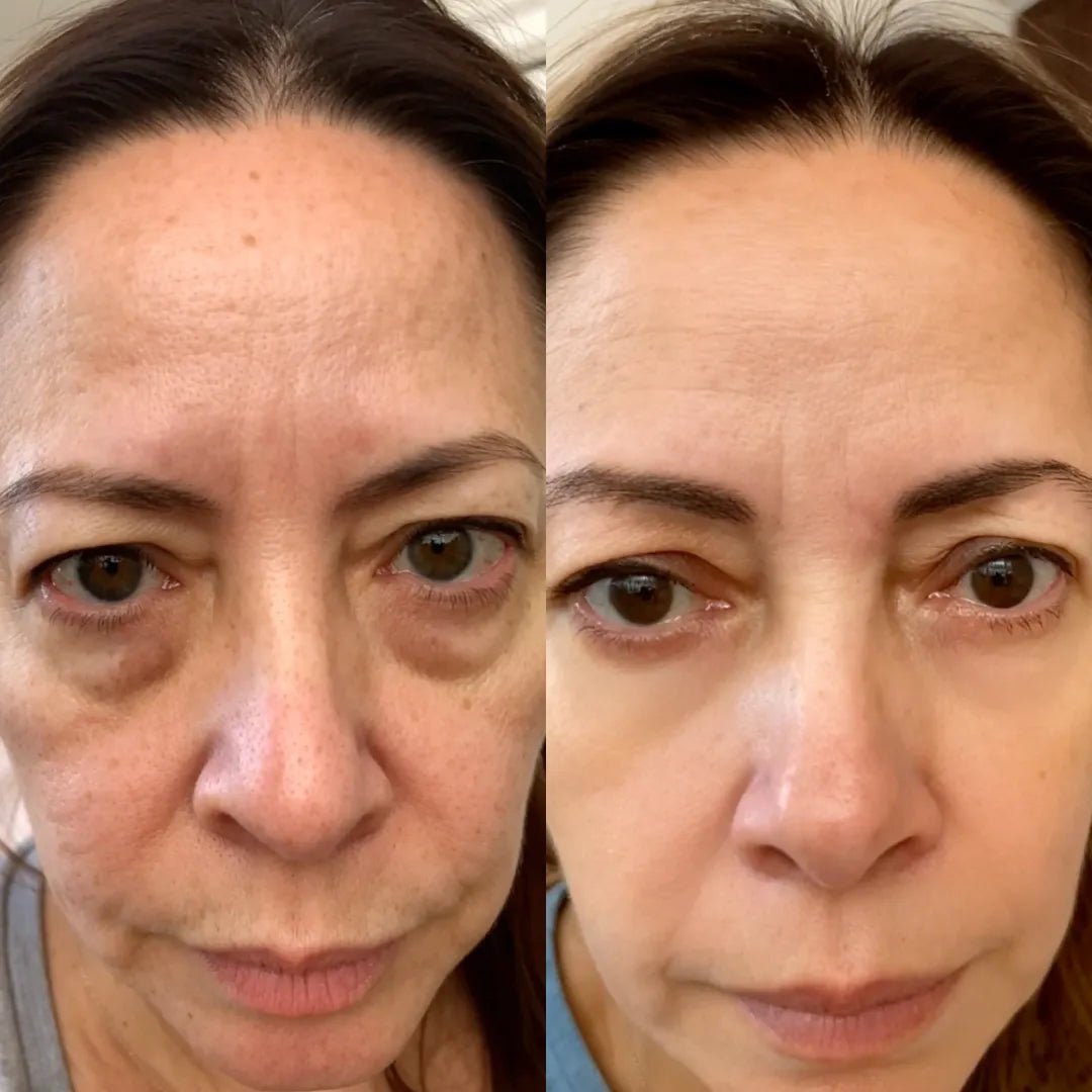 Antes y después del contorno de ojos