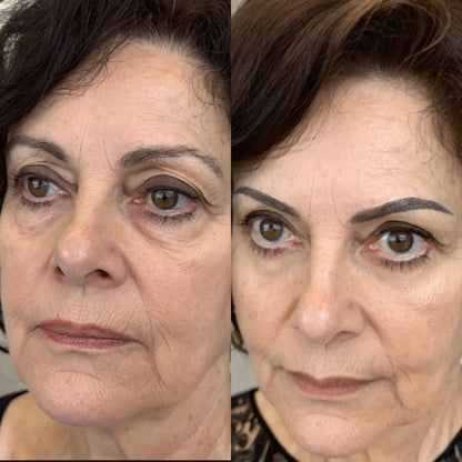 Antes y después del contorno de ojos
