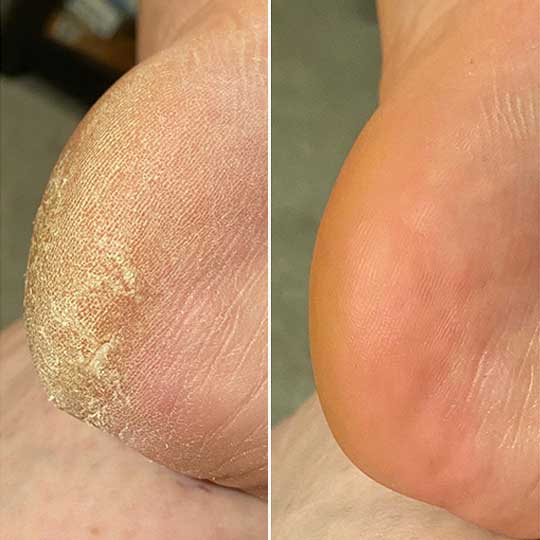 Talon antes y despues de usar Nivora Silk 3 Pro