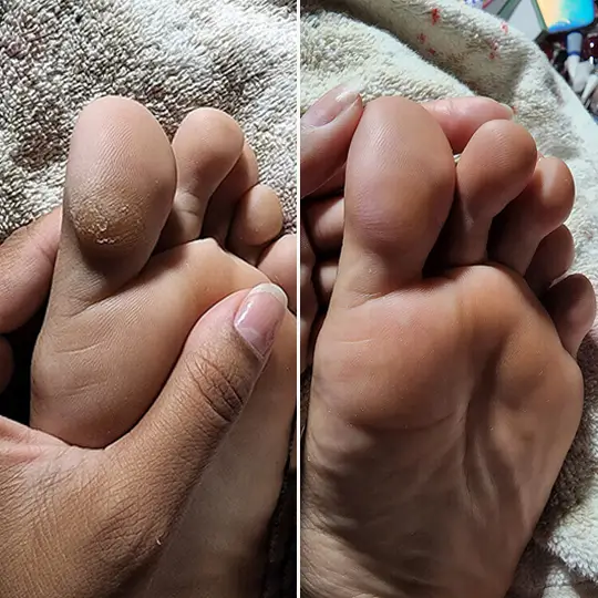 Callo en el dedo antes y despues de Nivora