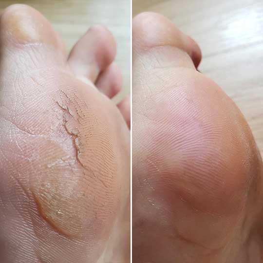 Planta del pie antes y despues de Nivora