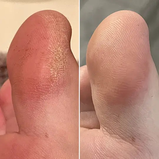 Dedo del pie antes y despues de Nivora