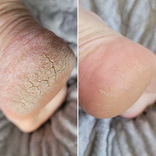 Talon partido antes y despues de Nivora